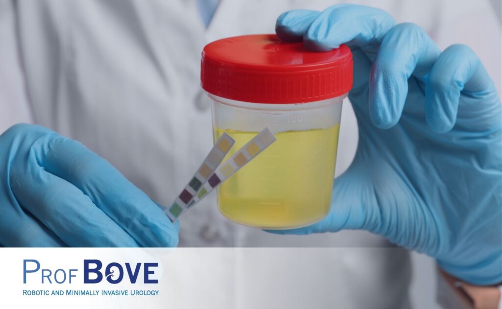 Pierluigi Bove Urologist FB Post - Positive urine culture Featured